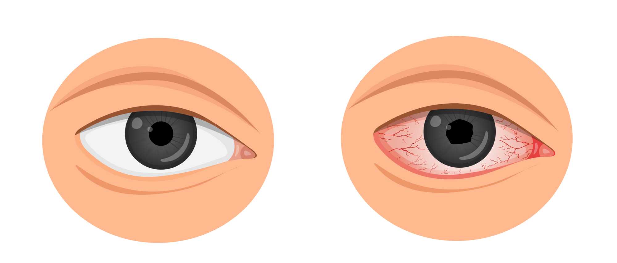 uveitis imagen